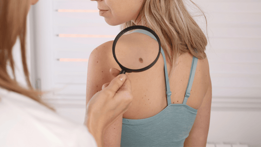 Natural Skin Tag Removal